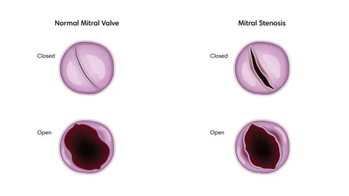 Estenose Mitral