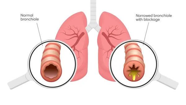 Entendendo os Sibilos Pulmonares (Wheeze)