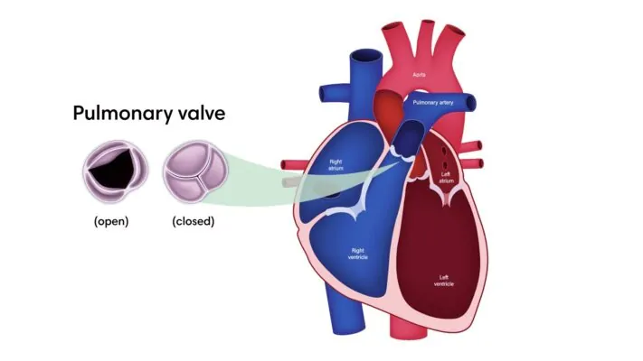 Doença da Válvula Pulmonar