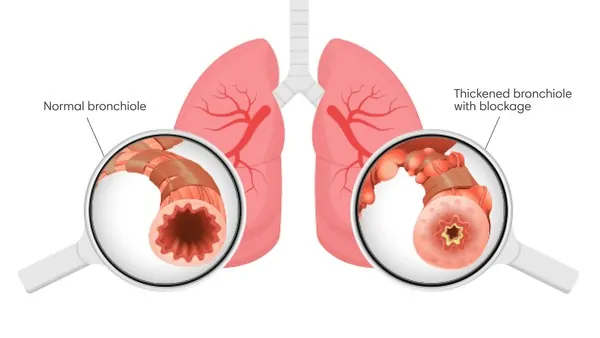 Entendendo os Estalos Pulmonares (Crackles)