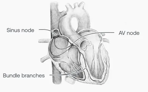 Fibrilação Atrial (FA)