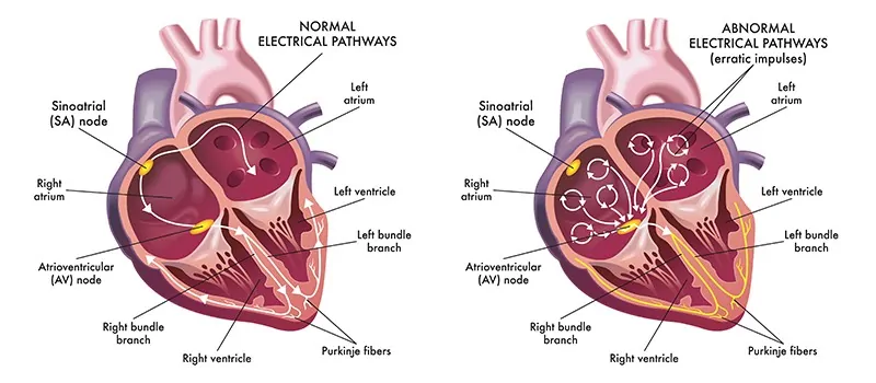 Fibrilação Atrial: Principais Fatos e Dados