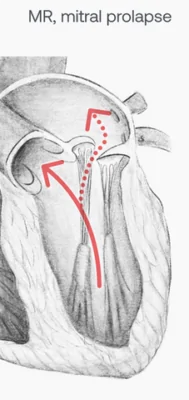 O Que é Regurgitação Mitral?